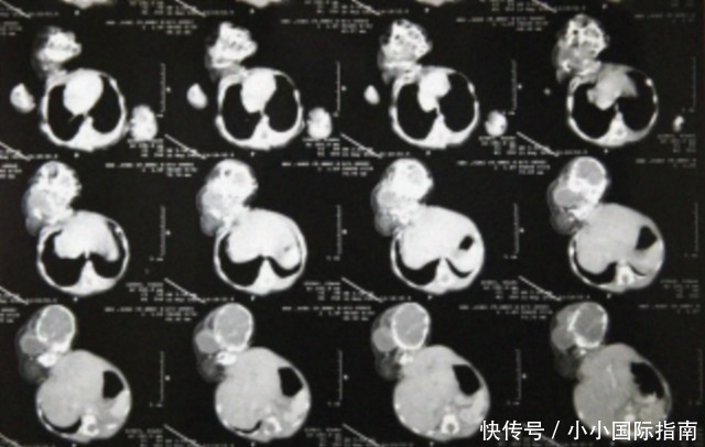 畸形|刚出生的双婴儿“第二个宝宝头颅”长在肚子上,心疼妈妈跟宝宝