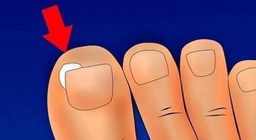 修剪|指甲长进肉里,一走路就疼,一个小办法可能对你有帮助,不妨一试