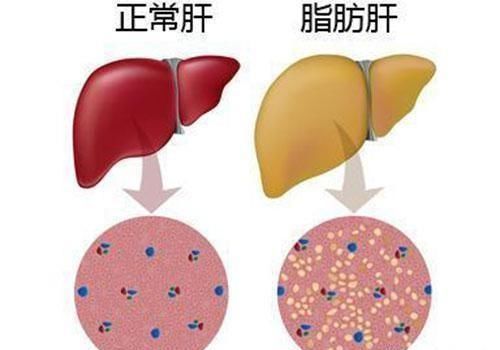  素食者|有脂肪肝的人可以多吃鸡蛋吗？为何素食者也会得脂肪肝？如何调理