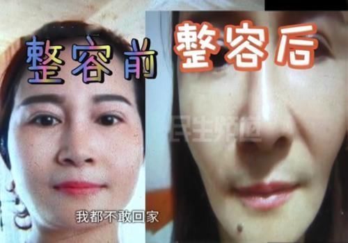 吸脂 为了让脸变尖一点 女子接受免费脸部吸脂手术 现在哭着想变回来