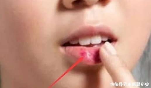 学生党“贼伤嘴巴”的3动作,多数00后已中招,变“火锅嘴”可别哭