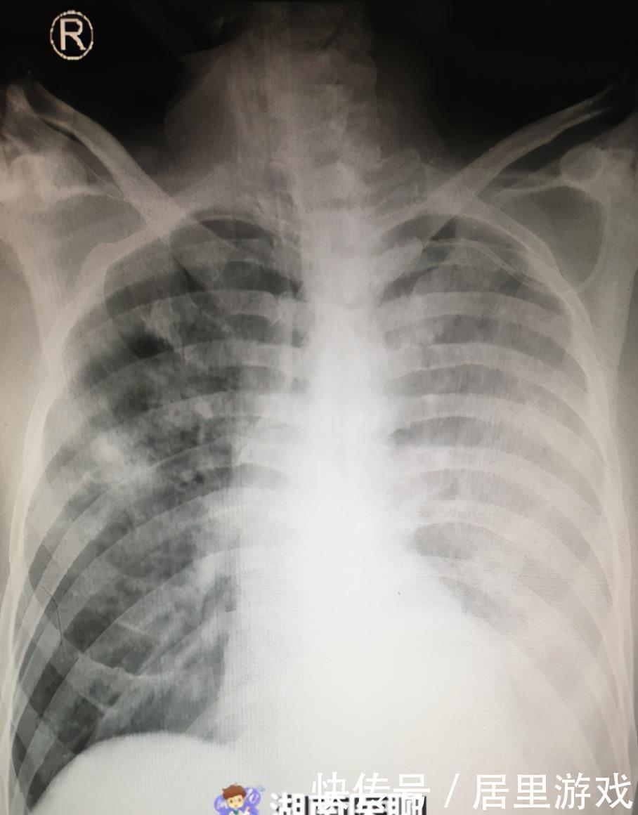 恐怖的“白肺”!男子呼吸紧促险休克!竟与养的鸡鸭有关?