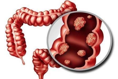大肠癌|大肠癌的早期症状有哪些 怎么预防大肠癌的发生