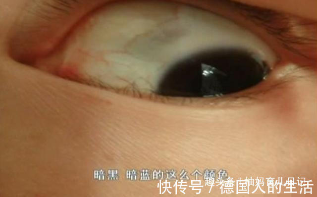 胎记|女娃眼里出现多个黑点,奶奶自以为的“哄娃神器”,正是罪魁祸首