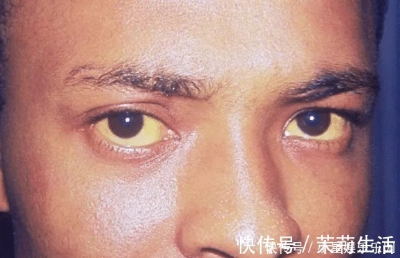 病变|养肝的“黄金组合”,不是枸杞菊花,平时多吃一点,肝脏变健康