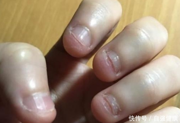 怎样才能让自己不啃指甲，苦甲水可以纠正咬指甲吗？