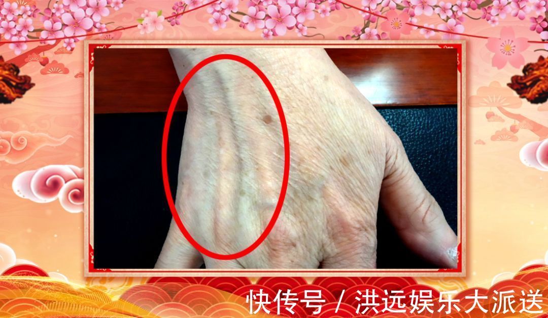 慢性心衰|身体好不好,看手就知道!这几处变化可能藏大病