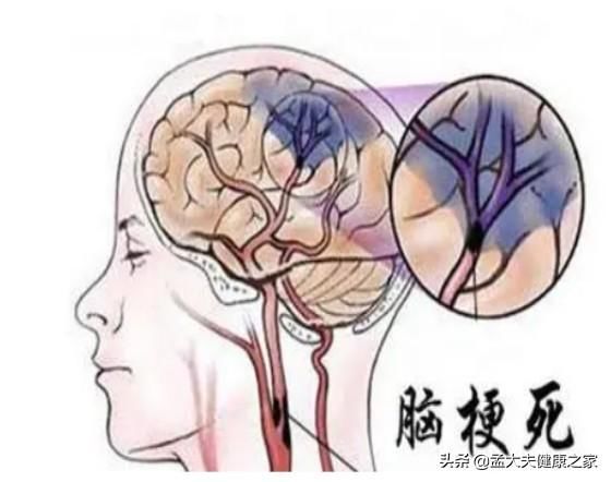 此文|老年人预防脑梗与老年痴呆，如何补充叶酸与B12很重要，请看此文