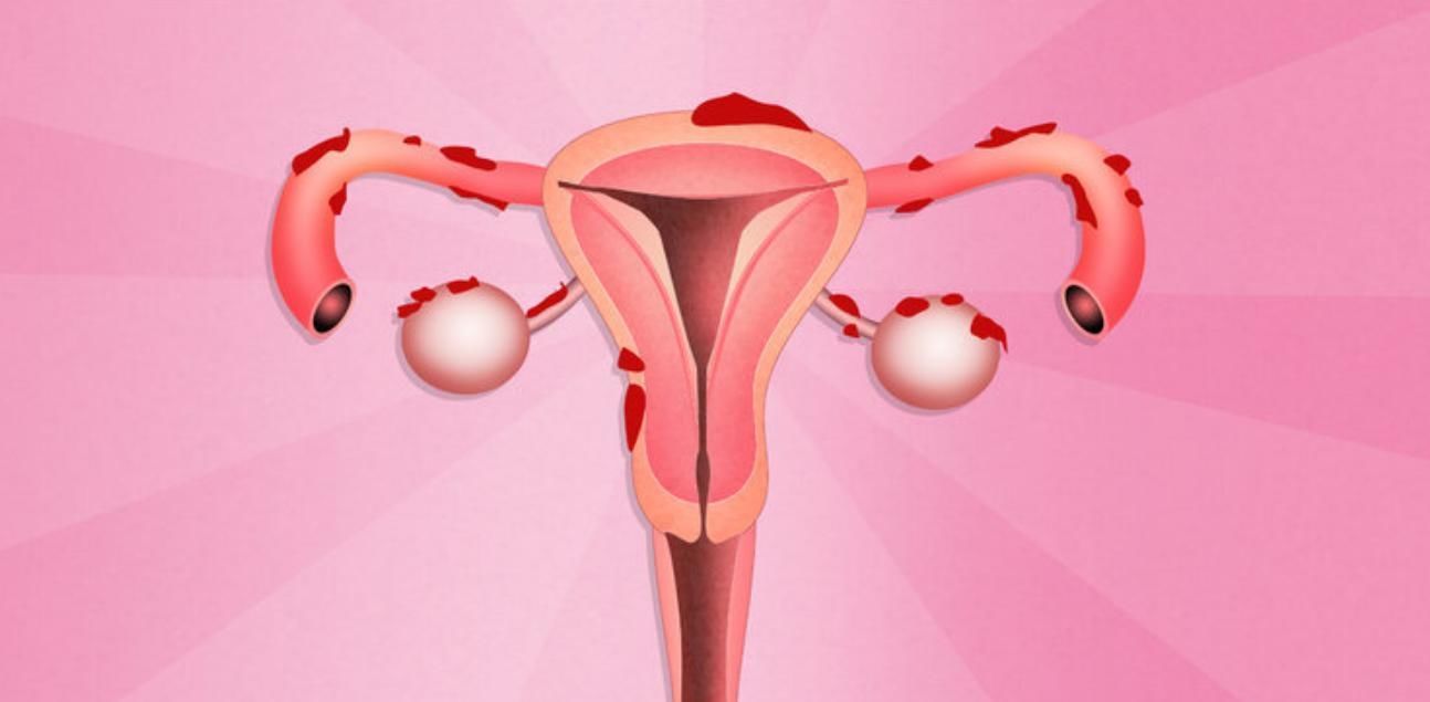 症状|“搞定”子宫肌瘤,3个方法任你选,别一拖再拖