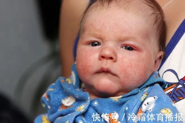 新生儿|宝宝湿疹反复太难缠,妈妈好心疼,对付宝宝湿疹弄懂这些很有必要