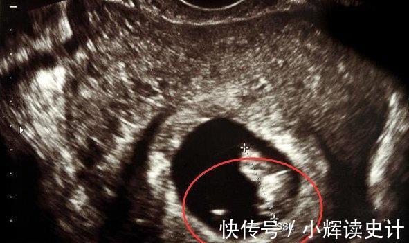 胎儿|怀孕6周,做B超还没看见胎心胎芽,是该坚持还是放弃?