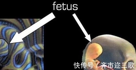 寄生胎|四岁男童肚子很大,刚开始以为是肿瘤,真相吓坏所有人!