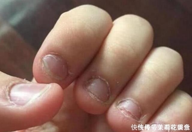 心理健康|自小“咬指甲”的孩子,长大后怎么样了医生逃不掉2种结局