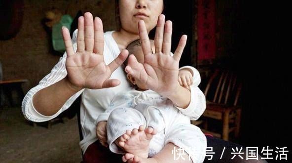 多指畸形|婴儿出生时有30多个手指医生看到了宝妈的手,明白了原因