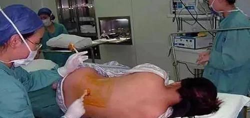 医生|顺产先苦后甜,剖腹产先甜后苦,而选择剖腹产的孕妈,这8种痛逃不掉