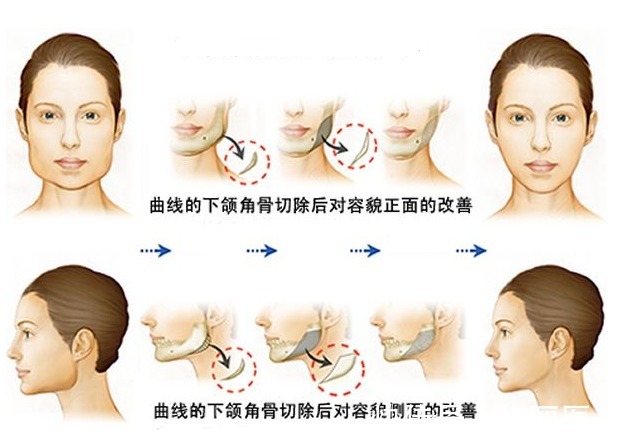 下颌角整形 下颌角磨骨恢复期需要多久？术后有哪些需要注意的，你都知道吗？