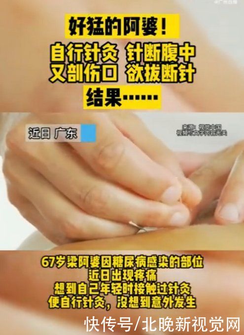 梁阿婆|想想就疼！67岁婆婆自行针灸，针断腹中后又……