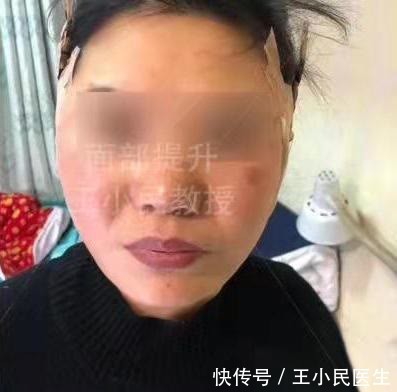 手术 拉皮除皱王小民教授：52岁做小拉皮一个月，看看她的变化！