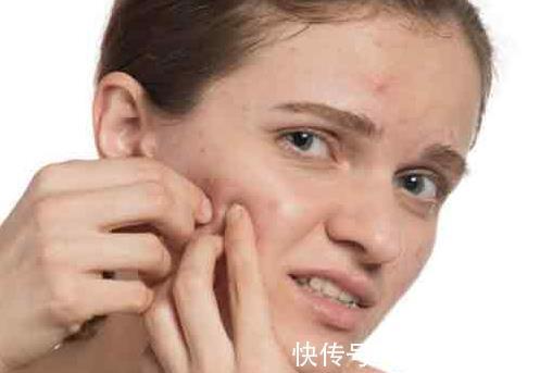 粉刺|神奇的中医外治法！面背部痤疮服汤药5年无效，穴位疗法一次即愈