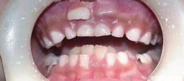 宝妈|宝妈们,孩子的双排牙可能都是你们造成的!