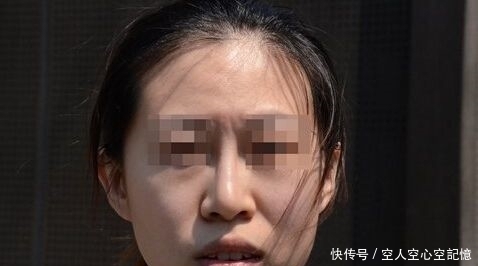 整鼻失败后,呼吸变得困难,工作人员表示:我新来的