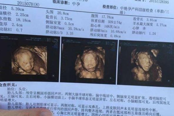 回事|不想生个“傻儿子”，孕期有三项检查不可少，准妈咪别不当回事