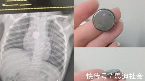 磁力球|6岁女童得怪病突然暴瘦,检查后医生让摘项链,妈妈:哪里有项链