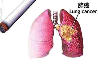 靶向治疗|肺癌患者想要长期生存,这几点误区要避开!