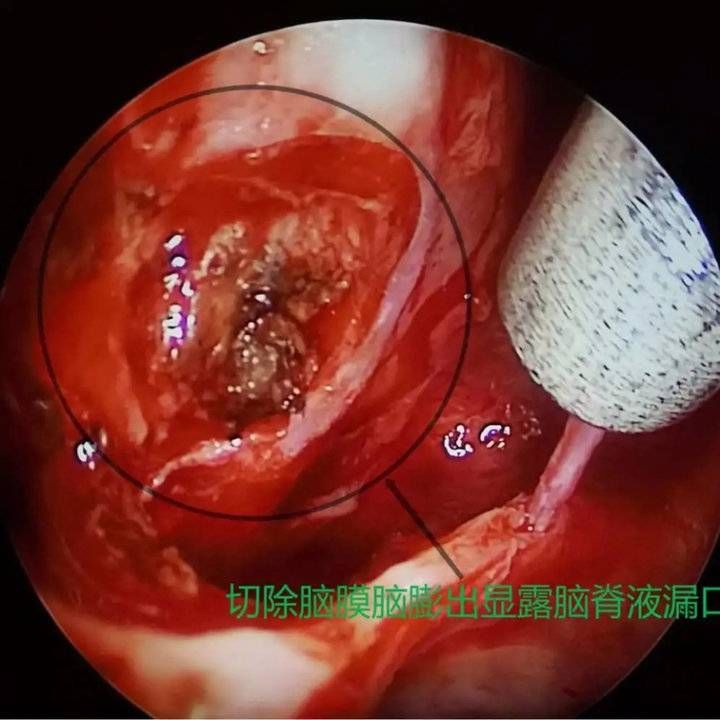 鼻内镜|流“鼻涕”一个多月,竟是脑脊液!鼻内镜下脑脊液修补术解难题