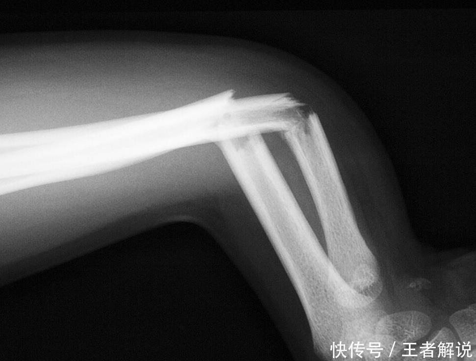 骨科医生告诫:餐桌上3种蔬菜,会使骨量流失加剧,日常别太贪吃