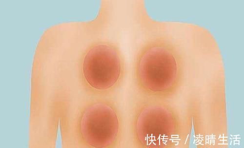 身体|拔完火罐后,身体上那些黑紫色的印记,是拔出来的毒素吗了解下