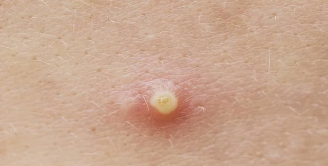 又长痘痘了怎么办可以用手挤吗注意以下几点,还你洁白肌肤