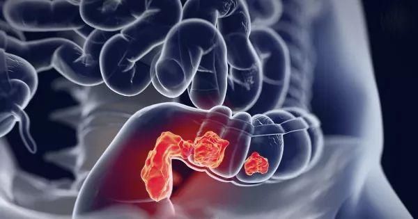 腹泻|不便秘不腹泻,32岁女子突然便血,一查竟是肠癌!