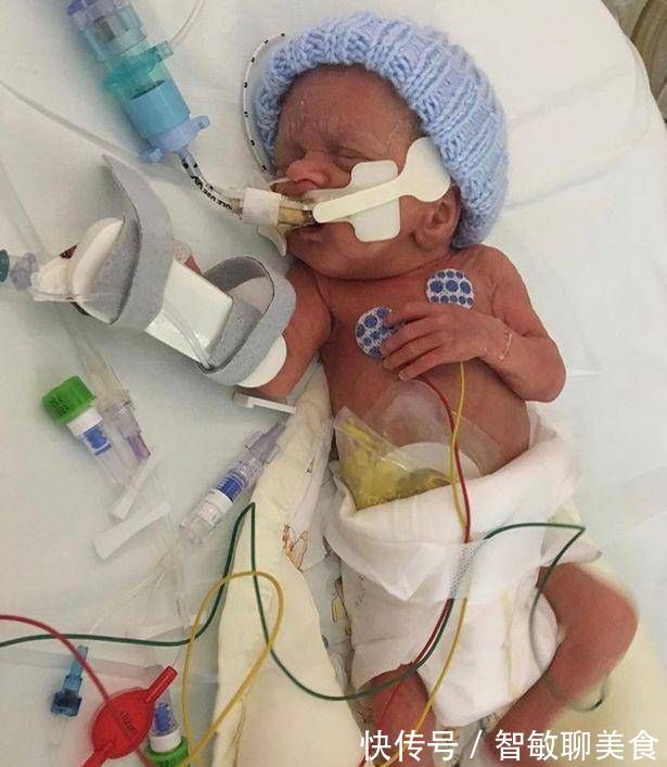 宝宝|英国妇女在怀孕21周时生下一个孩子宝宝是透明的,可以看到体内的血液流动