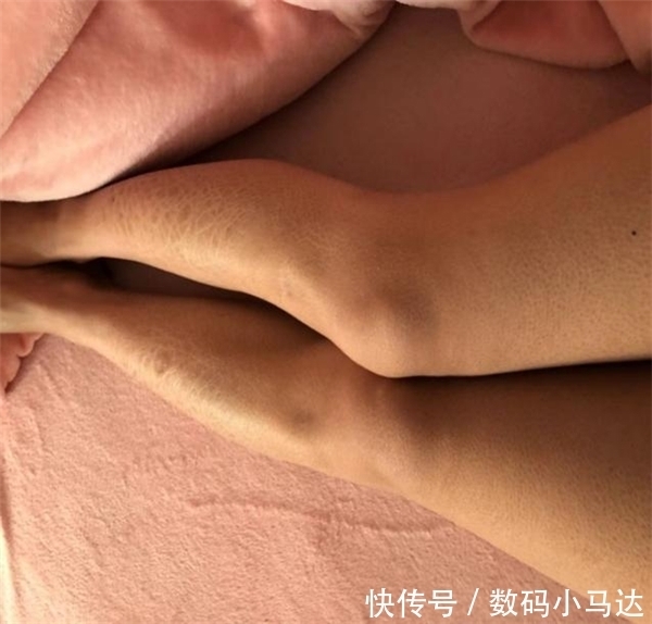 28岁宝妈晒“鱼鳞病皮肤”火了,网友:早点知道就好啦