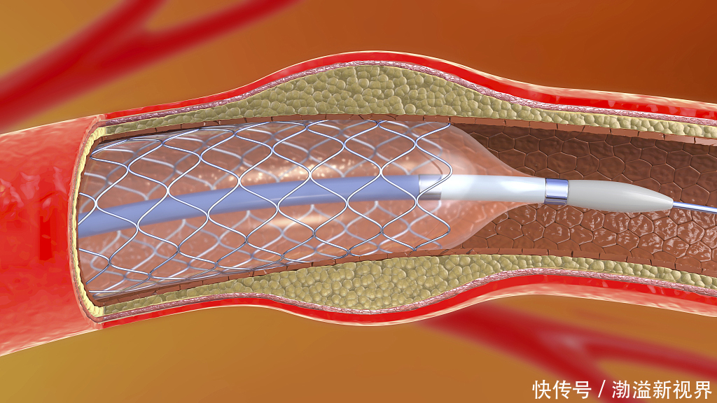 血管的天然支架！5块钱不到，对心脏病、血管硬