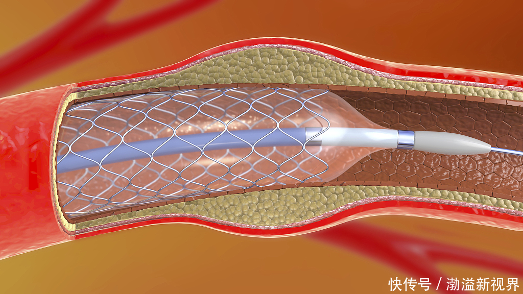 血管的天然支架!5块钱不到,对心脏病、血管硬