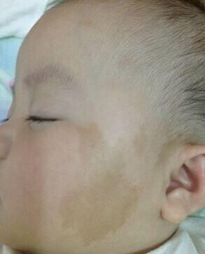 胎记|宝宝身上这3种“印记”,可能藏着疾病,发现了要及时去医院!