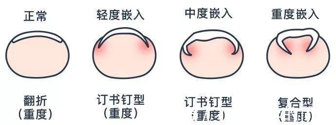 剪指甲|给婴幼儿剪指甲可不简单, 我的孩子被剪成了甲沟炎!