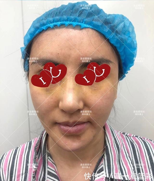 手术 40多岁大姐小拉皮手术全过程分享!