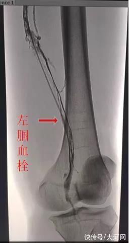 滤器|河南男子腿静脉血栓危及生命 医生：久坐不动是下肢深静脉血栓诱因之一