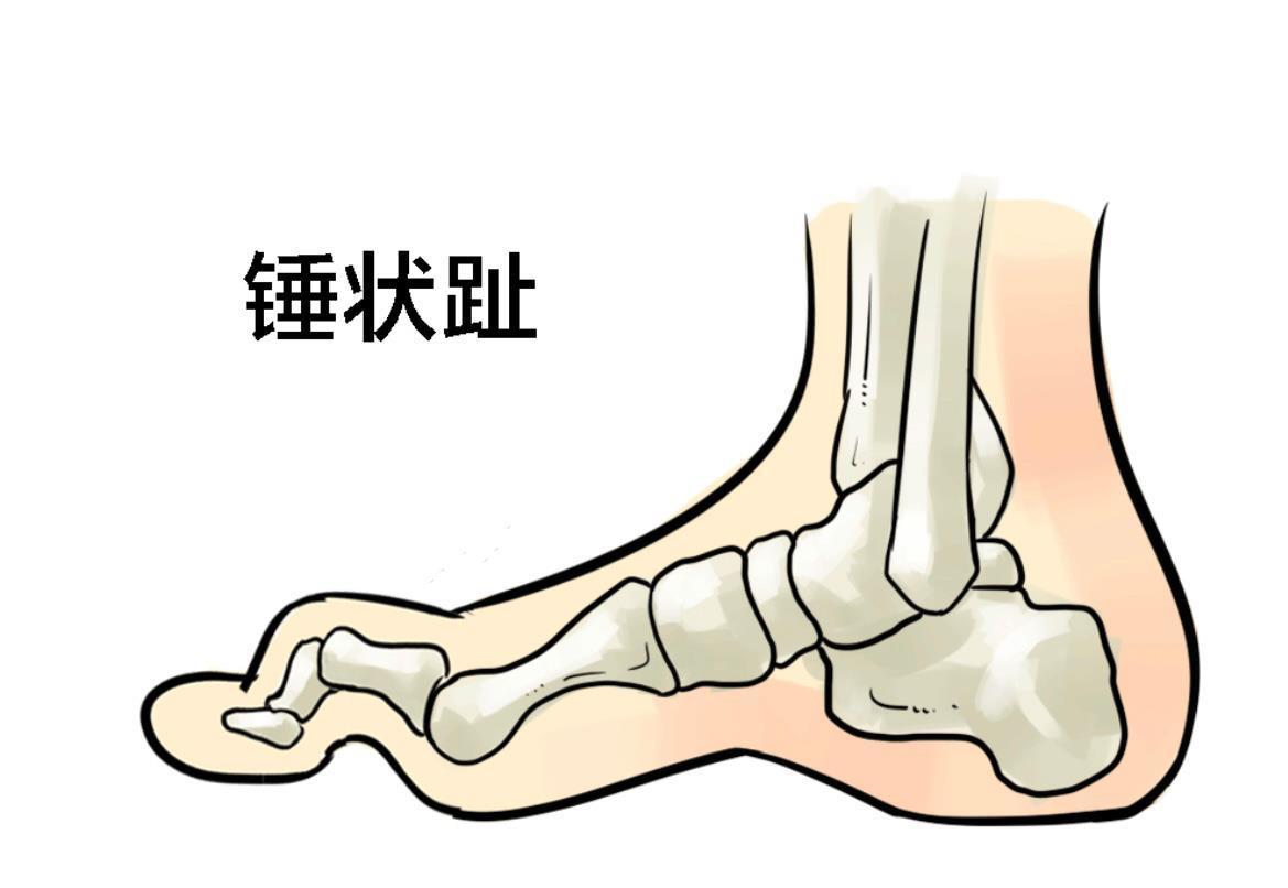 大姐|大姐骨折、小腿肌肉萎缩后的教训！买不好老人鞋，委屈的不是脚！