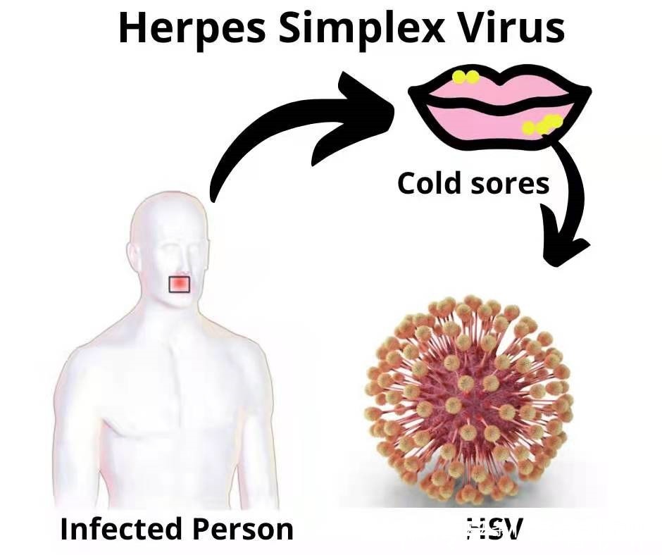 感染|2个月内3名幼童脑死亡!嘴角长这种水泡,真不是“上火”那么简单