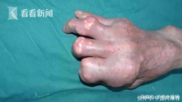 胰岛素抵抗|皮肤长出石头?六旬老伯长期吃海鲜手脚严重变形