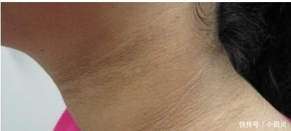 医院|9岁小女孩脖颈发黑洗不掉,经医院检查后,医生的话却让家长笑了