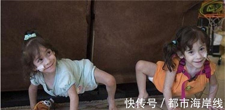 一条腿|3岁连体姐妹,成功做了人体分离手术,可惜术后每人只有一条腿