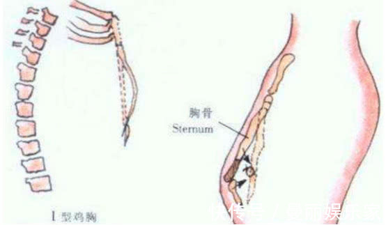 鸡胸|为什么患上“鸡胸”的宝宝越来越多做父母的责任很大啊