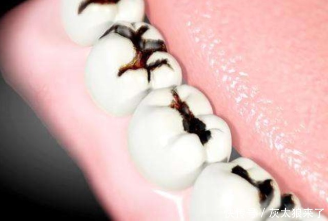 蛀牙真是被“蛀虫”咬的吗?3D动画演示全程,看着都感觉疼!