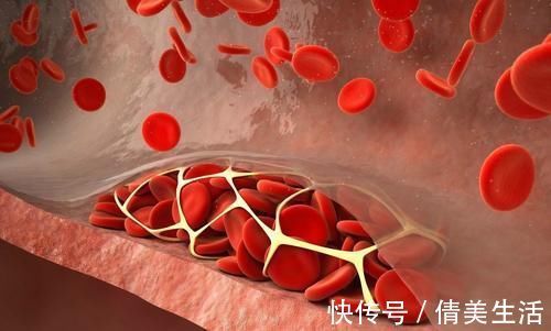 高血脂|49岁大姐不到3个月，甘油三酯从7.6降到1.7，分享经验：坚持做3事