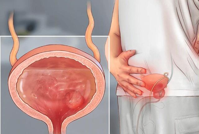 医生|小伙被前列腺炎折磨3年，2个月后炎症消除，医生他学会2个妙招